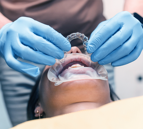 Ortodonzia adulti con una persona che indossa guanti blu sta applicando un allineatore dentale trasparente sui denti di un paziente di Dental Children, che è sdraiato con un divaricatore in posizione, esponendo i denti per la procedura dentale.