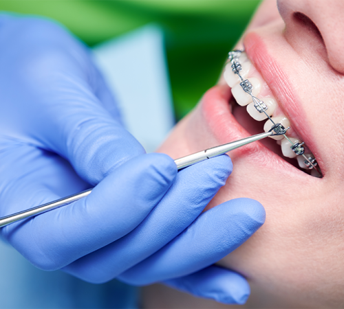 Ortodonzia adulti con un primo piano della bocca di un adulto con apparecchio ortodontico, mentre un dentista con guanti blu usa uno strumento dentale per esaminare o regolare le staffe e i fili ortodontici durante un controllo dentistico di routine per adulti.