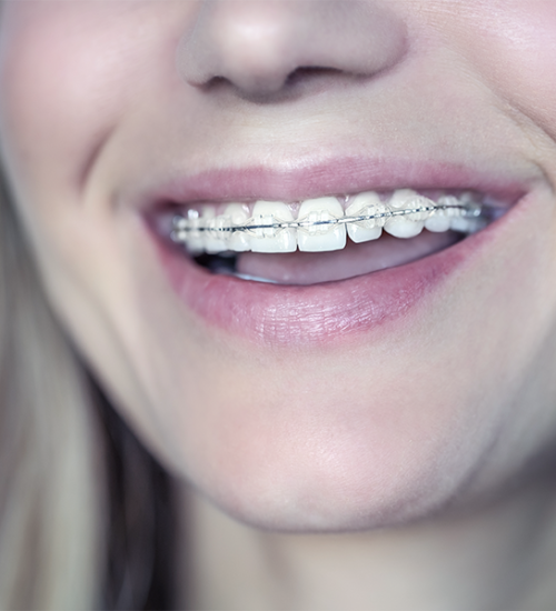 Check up-ortodontico adulti con un primo piano di una persona sorridente che mostra i propri denti con un apparecchio ortodontico trasparente, evidenziando il trattamento dentale di raddrizzamento. È visibile solo la metà inferiore del viso.