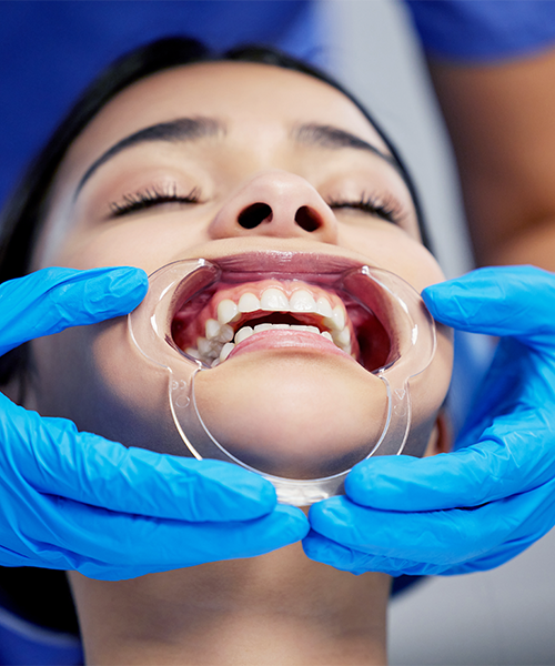 Check-up ortodontico bambini con un dentista con guanti blu usa un divaricatore di plastica per esaminare i denti di un bambino. Il paziente è appoggiato all'indietro con la bocca aperta, mostrando i denti e le gengive.