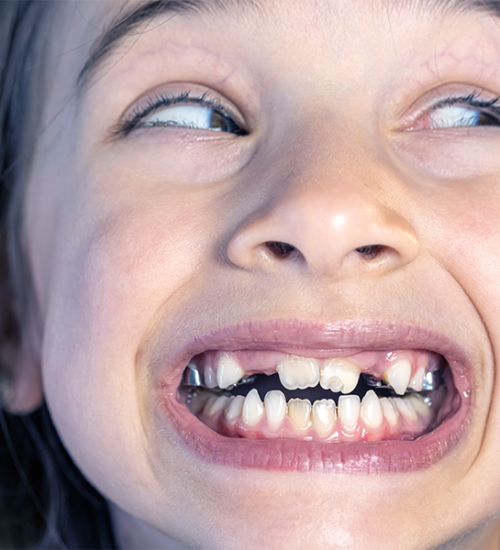 Apparecchio denti bambini con una bambina sorridente con denti da latte e dentizione in fase di crescita, fotografia ravvicinata.