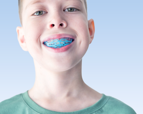 Paradenti bambini su un bambino che sorride indossando un paradenti per bambini di colore azzurro