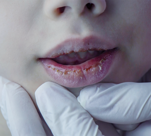 Paradenti bambini con un primo piano delle labbra irritate e screpolate di un bambino durante una valutazione clinica da parte di un professionista sanitario con guanti