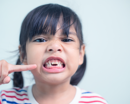 Estrazione dente latte per una bambina con capelli scuri raccolti in due codini è ripresa in primo piano mentre apre la bocca e mostra i denti. Indica con il dito indice della mano sinistra uno spazio vuoto nella parte inferiore della bocca, dove manca un dente da latte. Indossa una maglietta a righe bianche, rosse e blu. Lo sfondo è chiaro e uniforme.
