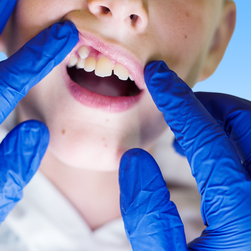 Estrazione dente soprannumerario bambino con un bambino che apre la bocca mentre due mani con guanti blu sollevano il labbro superiore per mostrare i denti, su sfondo azzurro uniforme.