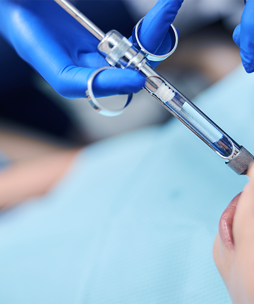 Estrazione dente soprannumerario bambino durante la preparazione, mentre una mano con guanto blu tiene una siringa odontoiatrica sopra il viso del piccolo paziente disteso sulla poltrona con bavaglino azzurro.
