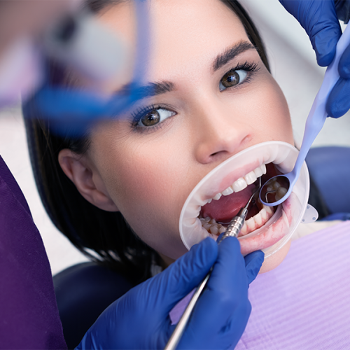 Estrazione dente deciduo durante una visita odontoiatrica, mentre una paziente tiene la bocca aperta con un divaricatore e due mani con guanti blu utilizzano specchietto e strumento metallico per esaminare i denti.