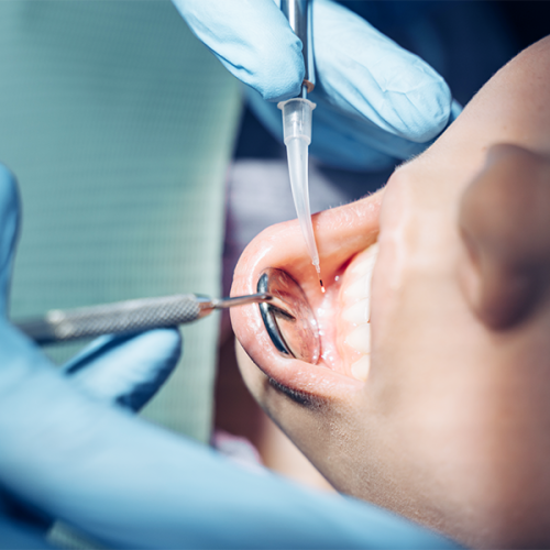 Dental debridement durante un trattamento odontoiatrico, mentre due mani con guanti blu utilizzano uno specchietto e uno strumento metallico all’interno della bocca del paziente insieme a una cannula per l’irrigazione.
