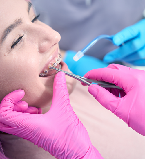 Dental debridement durante un controllo odontoiatrico, mentre una paziente con apparecchio ortodontico riceve la pulizia dei denti da due mani con guanti rosa che utilizzano strumenti metallici e da una terza mano con guanto blu che maneggia la cannula di aspirazione.