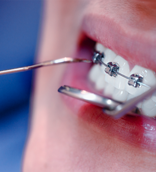 Dental debridement durante un intervento odontoiatrico, mentre strumenti metallici vengono utilizzati per pulire e lavorare sui denti con apparecchio ortodontico in una vista ravvicinata della bocca del paziente.