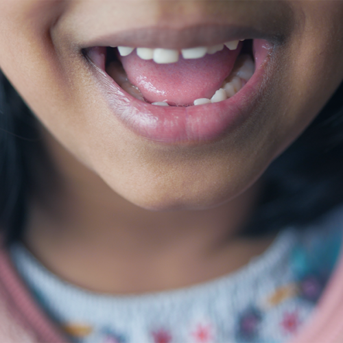 Odontoiatria pediatrica rappresentata dal primo piano della bocca di una bambina che sorride mostrando i denti da latte e la lingua, con labbra lucide e maglietta colorata visibile in parte.