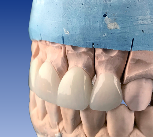 Ricostruzione dente rotto bambino mostrata attraverso un modello dentale in gesso con la parte superiore azzurra e diversi incisivi anteriori ricostruiti con materiali protesici chiari, in una vista ravvicinata su sfondo blu sfumato.