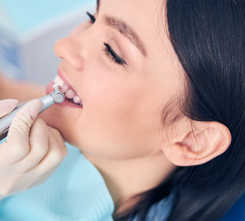 Otturazione dente bambino eseguita da un dentista mentre una paziente sorride durante la lucidatura di un dente con uno strumento rotante, tenuto da una mano con guanto chiaro in uno studio odontoiatrico.