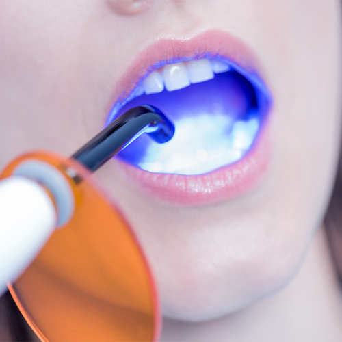 Trauma dentale bambino rappresentato da un primo piano della bocca di una paziente mentre un dentista utilizza una lampada polimerizzante a luce blu durante un trattamento odontoiatrico.