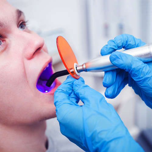 fluoroprofilassi infantile mostra come fotopolimerizzare il materiale protettivo con lampada polimerizzante in studio dentistico.