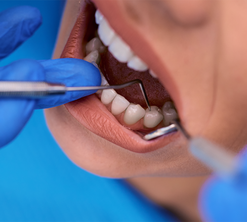 Curettage dentale bambini mostra il trattamento odontoiatrico eseguito su un bambino da un dentista