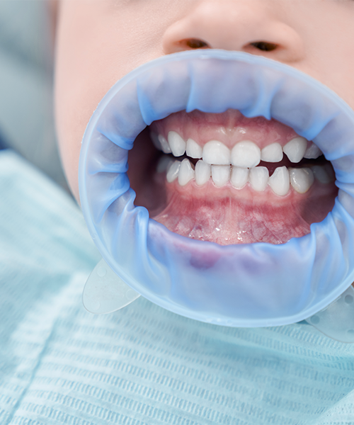Curettage dentale bambini mostra la bocca del bambino preparata per il trattamento con divaricatore