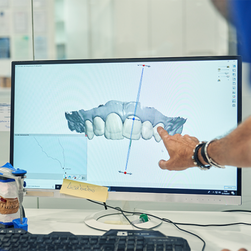 Terapia ortodontica per adulti analizza la scansione digitale dei denti su monitor durante la pianificazione del trattamento