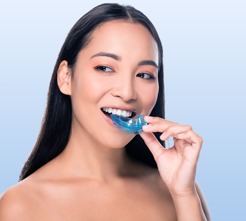 Byte per bruxismo per una donna adulta che inserisce un byte trasparente blu tra i denti, evidenziando l’utilizzo del dispositivo per proteggere lo smalto e ridurre gli effetti del digrignamento notturno.