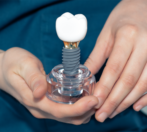 Protesi dentale mostra una persona in camice blu che tiene in mano un modello di impianto dentale, con un dente artificiale realistico attaccato a una vite metallica, montato su una base trasparente.