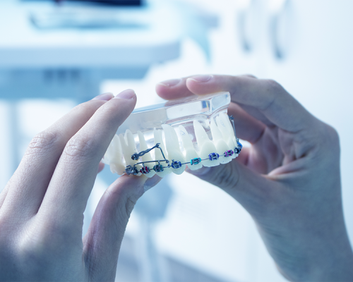 Protesi dentale mostra una persona che tiene in mano un modello dentale che mostra denti dotati di apparecchi ortodontici e di apparecchi metallici, su uno sfondo clinico sfocato.