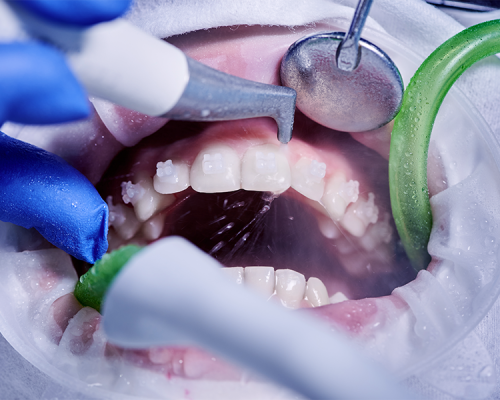 Chirurgia parodontale mostra un primo piano della bocca di una persona sottoposta a trattamento odontoiatrico, con strumenti dentali che puliscono i denti dotati di apparecchio e un tubo di aspirazione che rimuove la saliva.