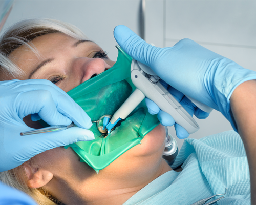 Ricostruzione dentale estetica mostra una paziente adulta sottoposta a un trattamento odontoiatrico con diga di gomma per isolare il dente durante la ricostruzione.