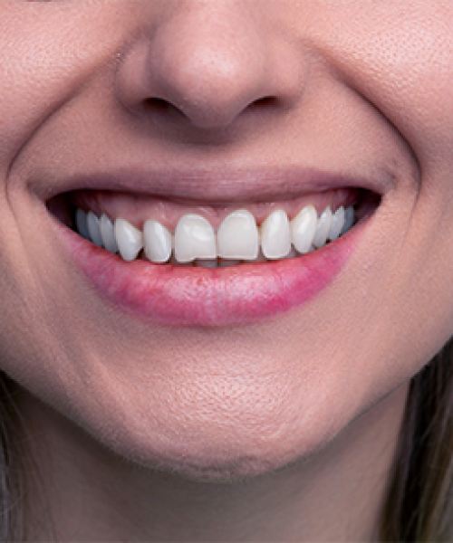 Ricostruzione dentale estetica evidenzia il sorriso di una donna adulta che mostra denti armoniosi e restaurati con un risultato estetico naturale
