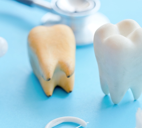 Ricostruzione dentale estetica confronta un dente danneggiato con un dente ricostruito, mettendo in evidenza la differenza estetica ottenuta grazie all’intervento odontoiatrico