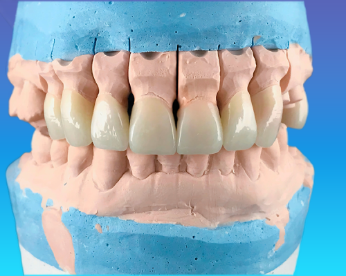 Otturazioni dentali mostra un modello dentale che evidenzia carie e deterioramenti, utilizzato per pianificare otturazioni precise e ripristinare la salute dei denti