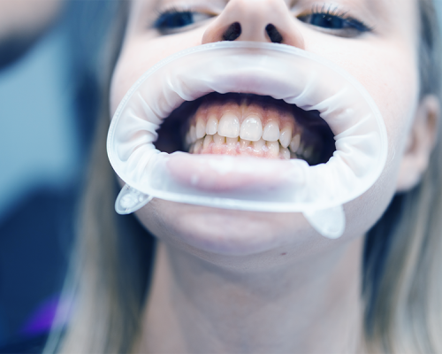Otturazioni dentali mostra una paziente con divaricatore orale che espone chiaramente l’arcata dentale per facilitare la valutazione e la preparazione del dente prima dell’otturazione