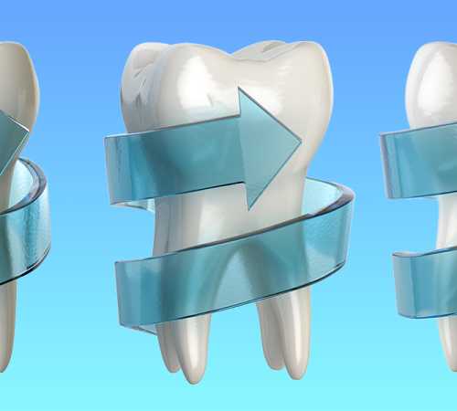 Trauma dentale mostra un dente con una freccia avvolgente che simboleggia movimento o spostamento dovuto a un trauma