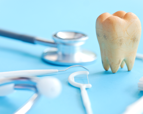 Ipomineralizzazione denti mostra il calco di un dente utilizzato per l'impianto su un paziente.