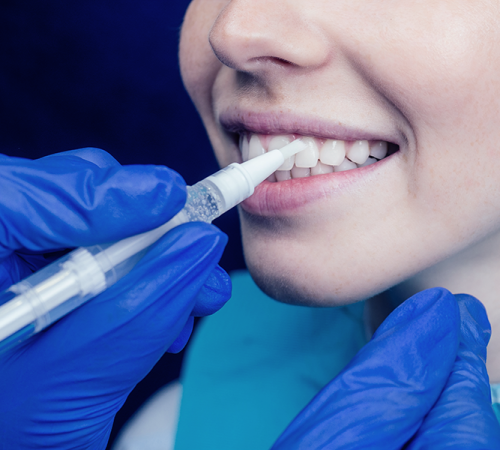 Ipomineralizzazione denti illustrata attraverso l’applicazione professionale di un trattamento remineralizzante