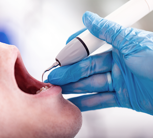 Igiene orale adulti: mostra un paziente adulto durante una seduta di igiene professionale, con strumenti ultrasonici utilizzati dall’odontoiatra per rimuovere placca e tartaro