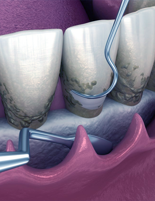 Igene orale adulti mostrato con la rimozione della placca dentale raffigurata da uno strumento odontoiatrico in azione per eliminare placca e tartaro dalla superficie dei denti