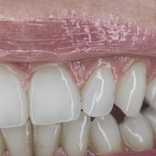 Fluoro profilassi adulti evidenzia il dettaglio di denti adulti sani dopo un trattamento professionale al fluoro