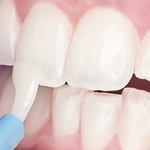 Fluoro profilassi adulti evidenzia l’applicazione di un materiale sulla superficie dentale per rinforzare lo smalto indebolito