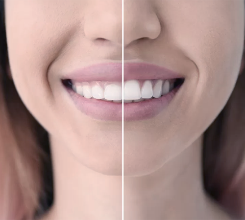 Immagine divisa della parte inferiore del viso di una donna sorridente, che mostra un confronto tra il prima e il dopo dello sbiancamento dei denti. Il lato sinistro mostra denti leggermente gialli, mentre il lato destro mostra denti sensibilmente più bianchi.