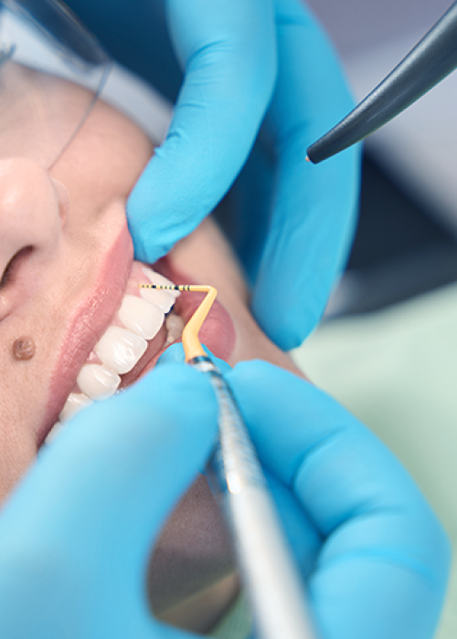 Una persona che indossa occhiali protettivi viene sottoposta a una visita odontoiatrica. Un dentista con guanti blu usa gli strumenti dentali per esaminare e pulire i denti della persona.