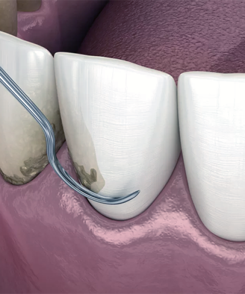 Uno strumento dentale viene utilizzato per rimuovere la placca o il tartaro dalla superficie di un dente anteriore inferiore vicino al bordo gengivale, con le gengive e i denti circostanti visibili.