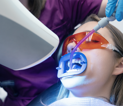 BlancOne Click evidenzia una paziente adulta sottoposta a sbiancamento dentale professionale con luce attivatrice e apribocca