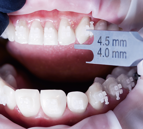 BlancOne Click mostra una paziente con la bozza aperta e il dentista con i guanti neri che tiene in mano un misuratore vicino ai denti della paziente con dei numeri progressivi, per misurare l'effetto dopo il trattamento