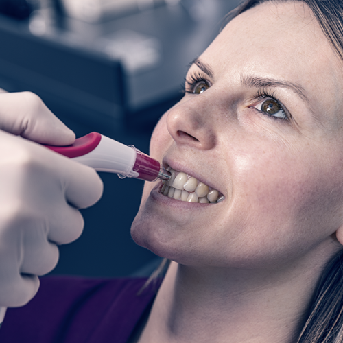 Sbiancamento dentale domiciliare Evidenzia una donna con la bocca aperta mentre un professionista applica un dispositivo simile a una pistola erogatrice sui denti per avviare il trattamento di sbiancamento.