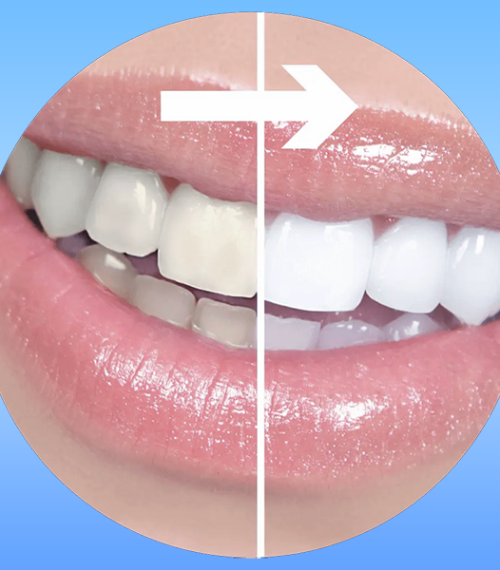 Sbiancamento dentale domiciliare evidenzia un confronto prima/dopo del trattamento: a sinistra denti opachi e ingialliti, a destra denti visibilmente più bianchi grazie allo sbiancamento.