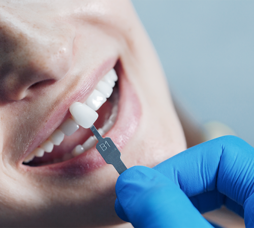 Implantologia dentale mostra un primo piano della bocca di una persona sorridente, mentre una mano guantata appoggia una faccetta dentale sui suoi denti, confrontandone il colore e l'adattamento.